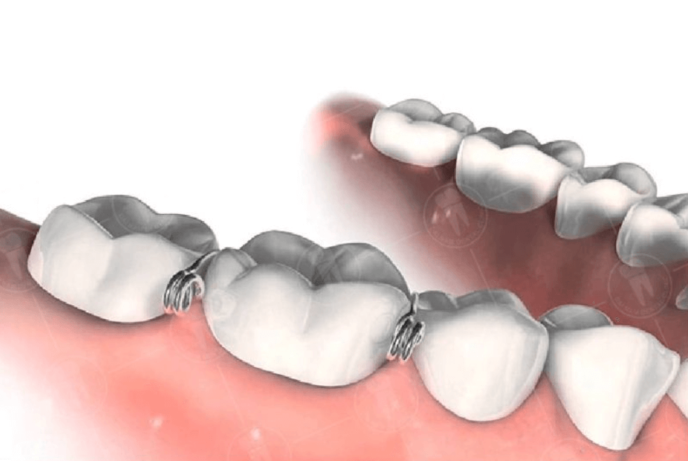 Thun tách kẽ kim loại
