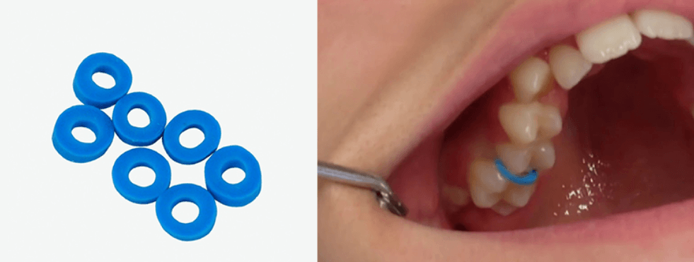 Ai cần và ai không cần đặt thun tách kẽ răng?