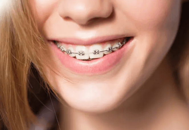 Quy trình đặt thun tách kẽ răng – mô tả chi tiết từng bước