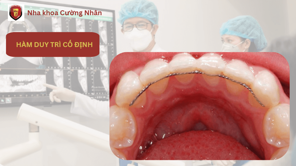 Hàm duy trì cố định (Fixed Retainer)