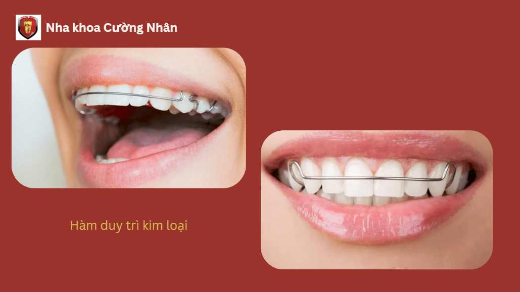 Hàm duy trì tháo lắp kim loại (Hawley Retainer)