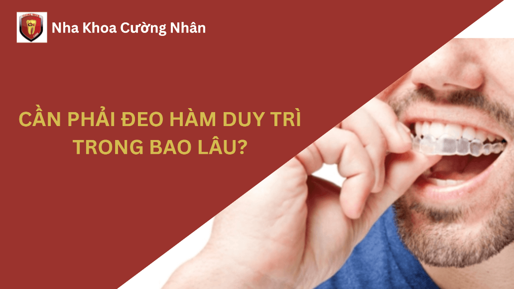 Cần phải đeo hàm duy trì trong bao lâu?