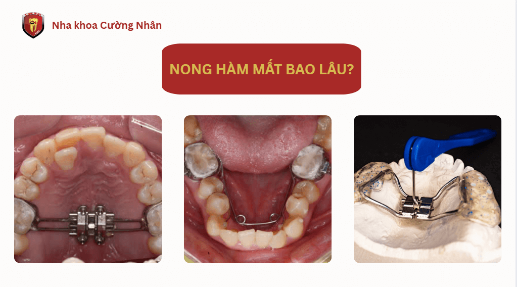 Thời gian nong hàm là bao lâu