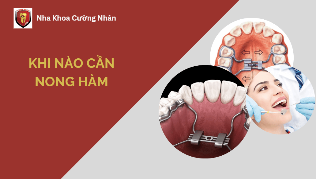 Khi nào bạn cần nong hàm - 5 nhóm điển hình