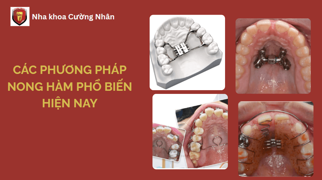 Hiện nay có 4 phương pháp nong hàm phổ biến