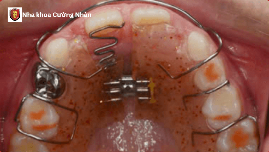 Phương pháp nong hàm chậm