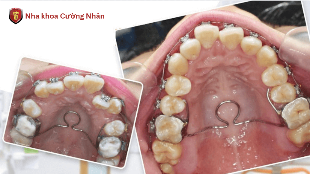 Phương pháp nong hàm bằng dây cung