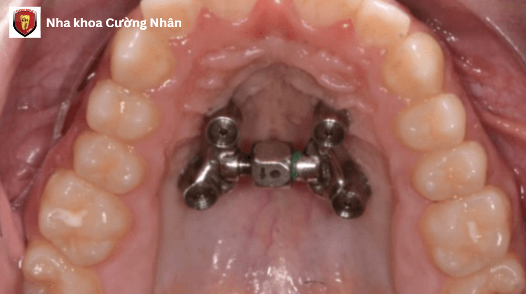 Phương pháp nong hàm có mini-implant hỗ trợ