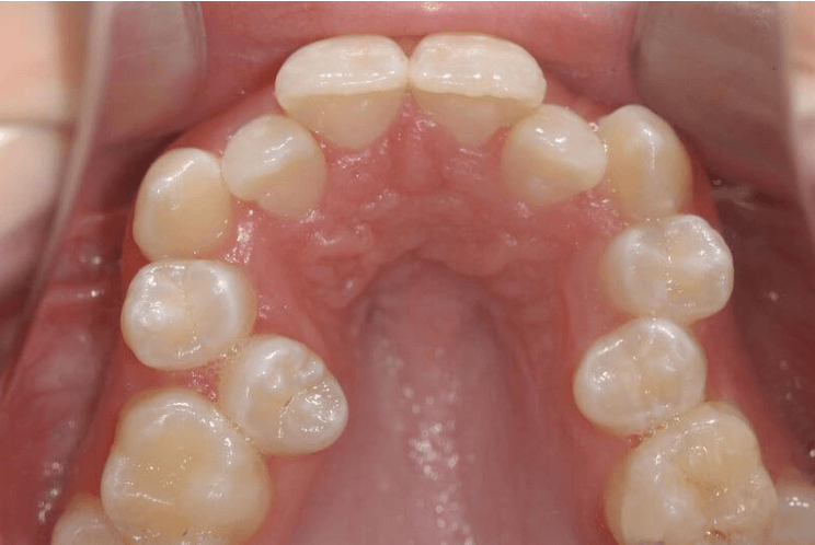 Tìm hiểu về răng mọc chen chúc