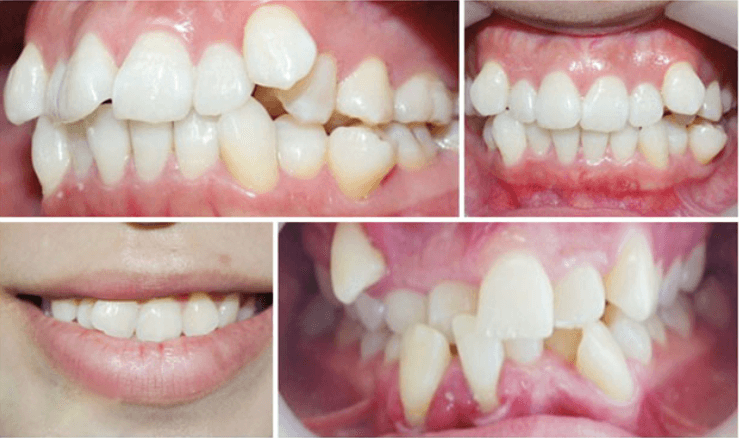 Phân độ răng mọc chen chúc theo tiêu chuẩn Orthodontics