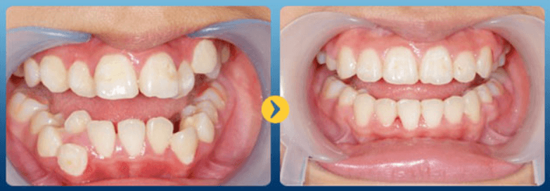 Niềng răng chỉnh nha