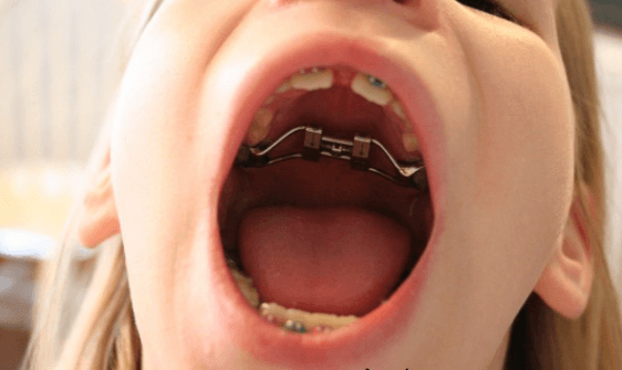 Nong hàm – khí cụ chức năng cho trẻ em