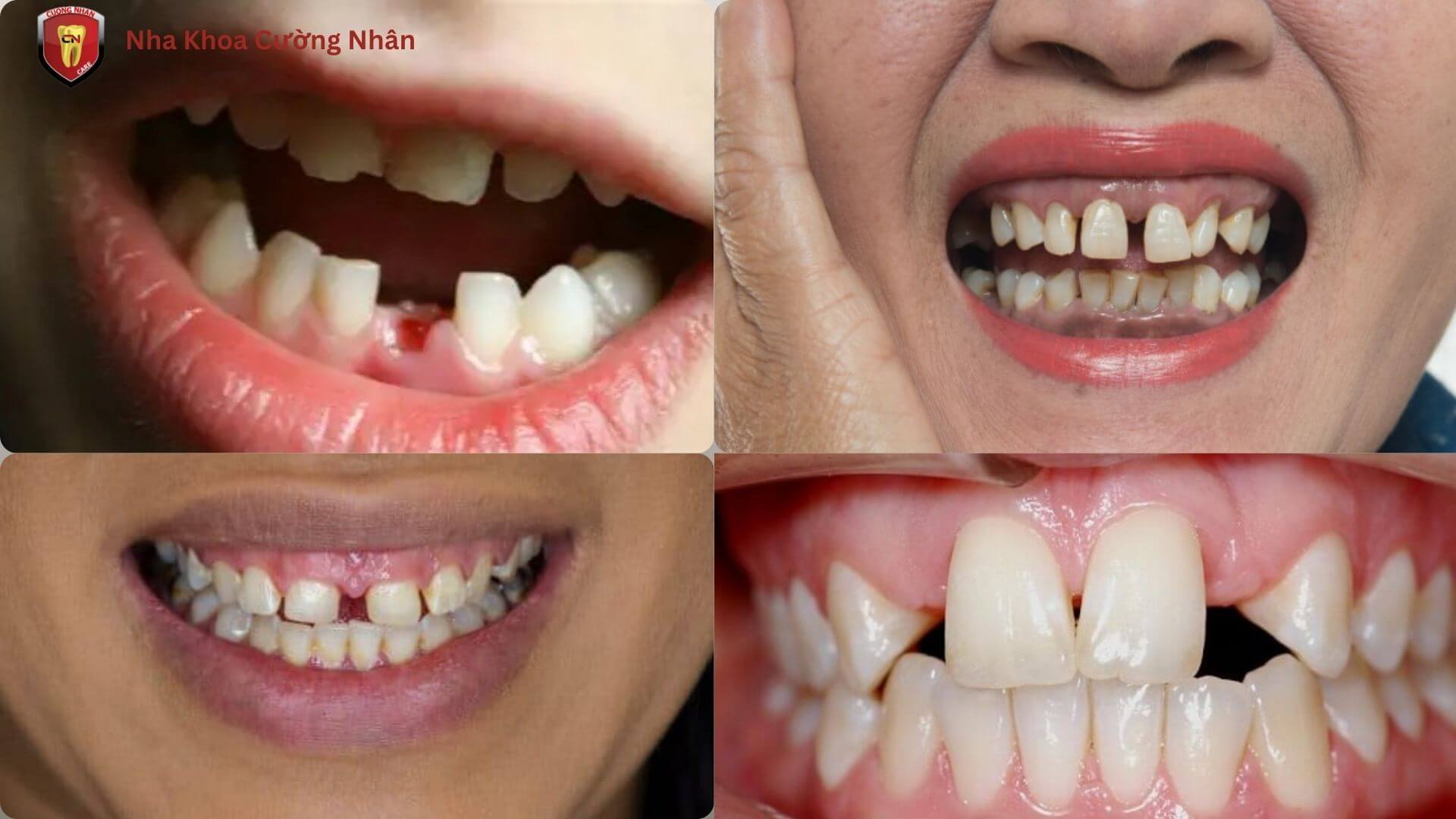 Tình trạng răng thưa nặng / răng thưa do thiếu răng