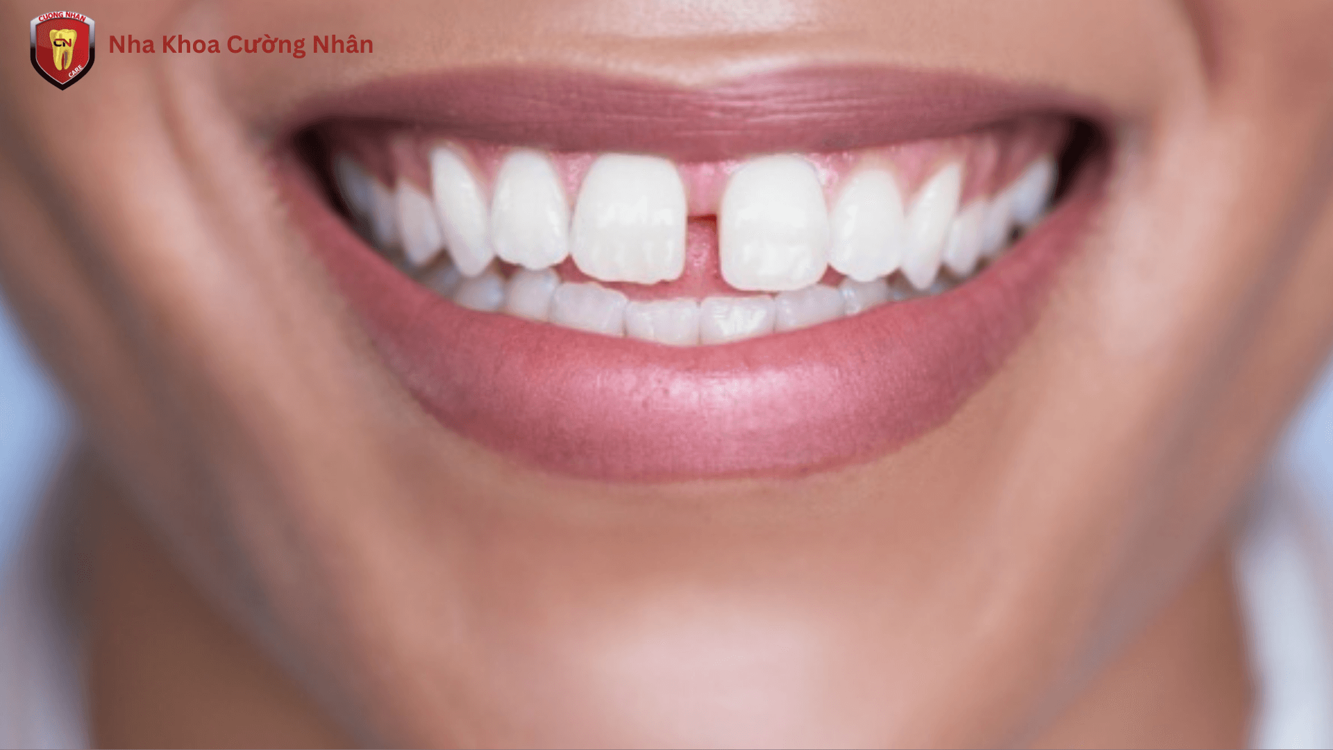 Răng thưa có thể khít lại tùy theo độ tuổi