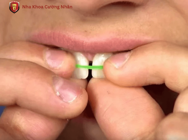 Phương pháp chữa thưa răng bằng dây chun