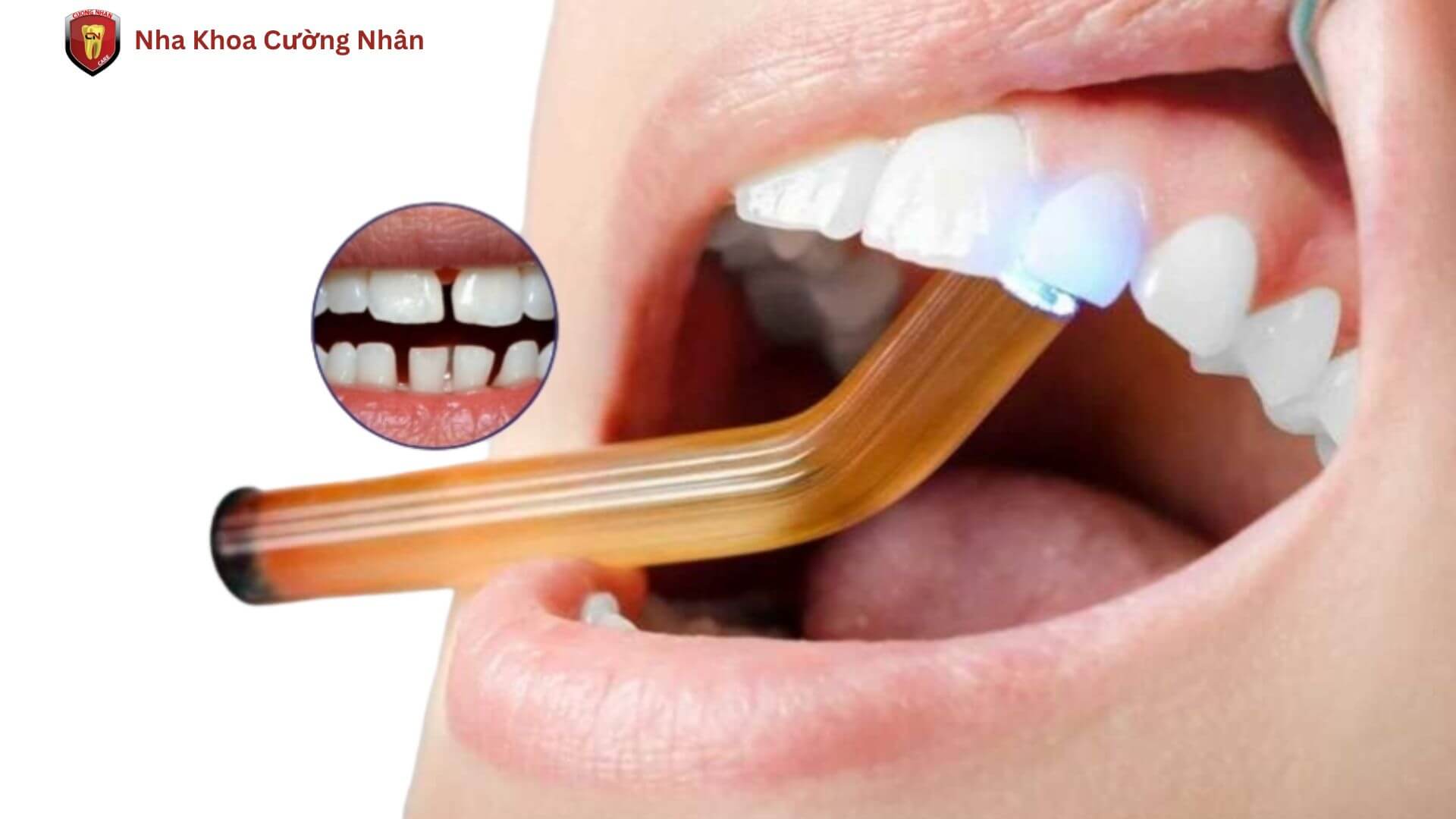 Phương pháp trám răng thưa để điều trị thưa răng