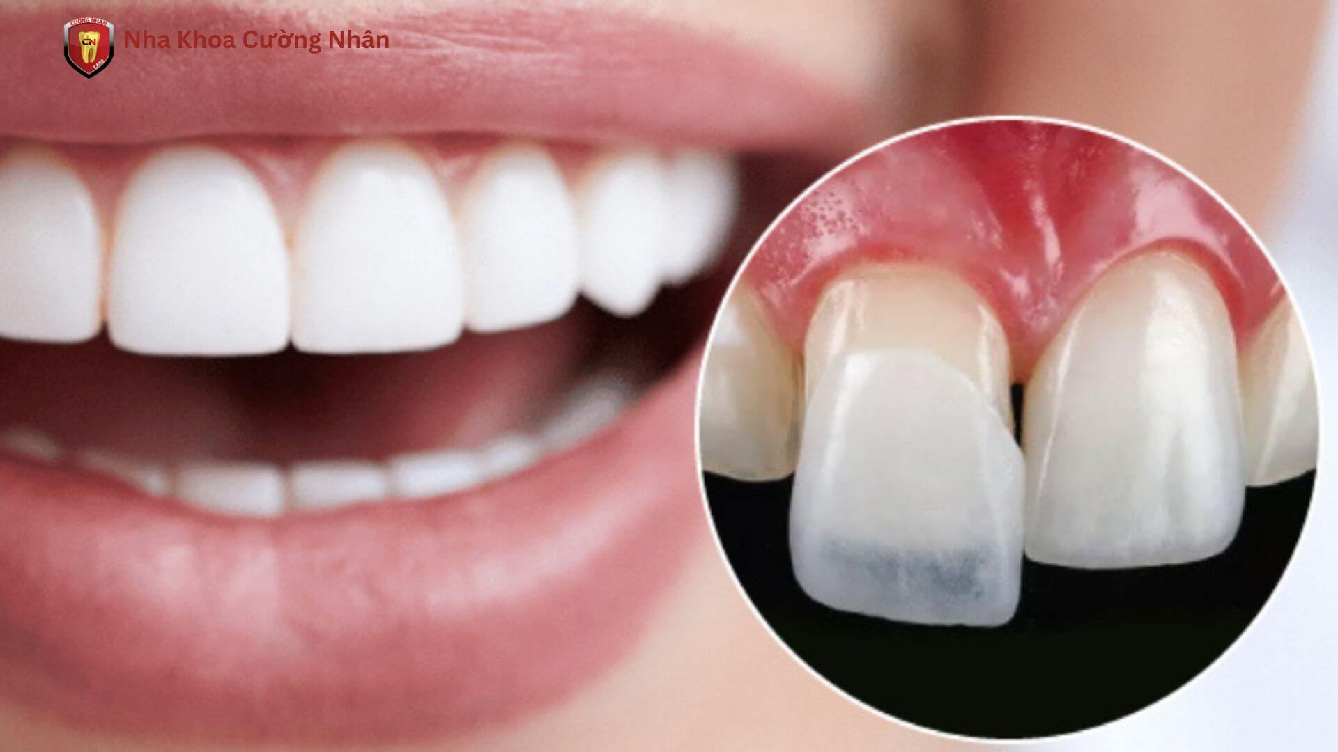 Phương pháp dán sứ Veneer để điều trị thưa răng