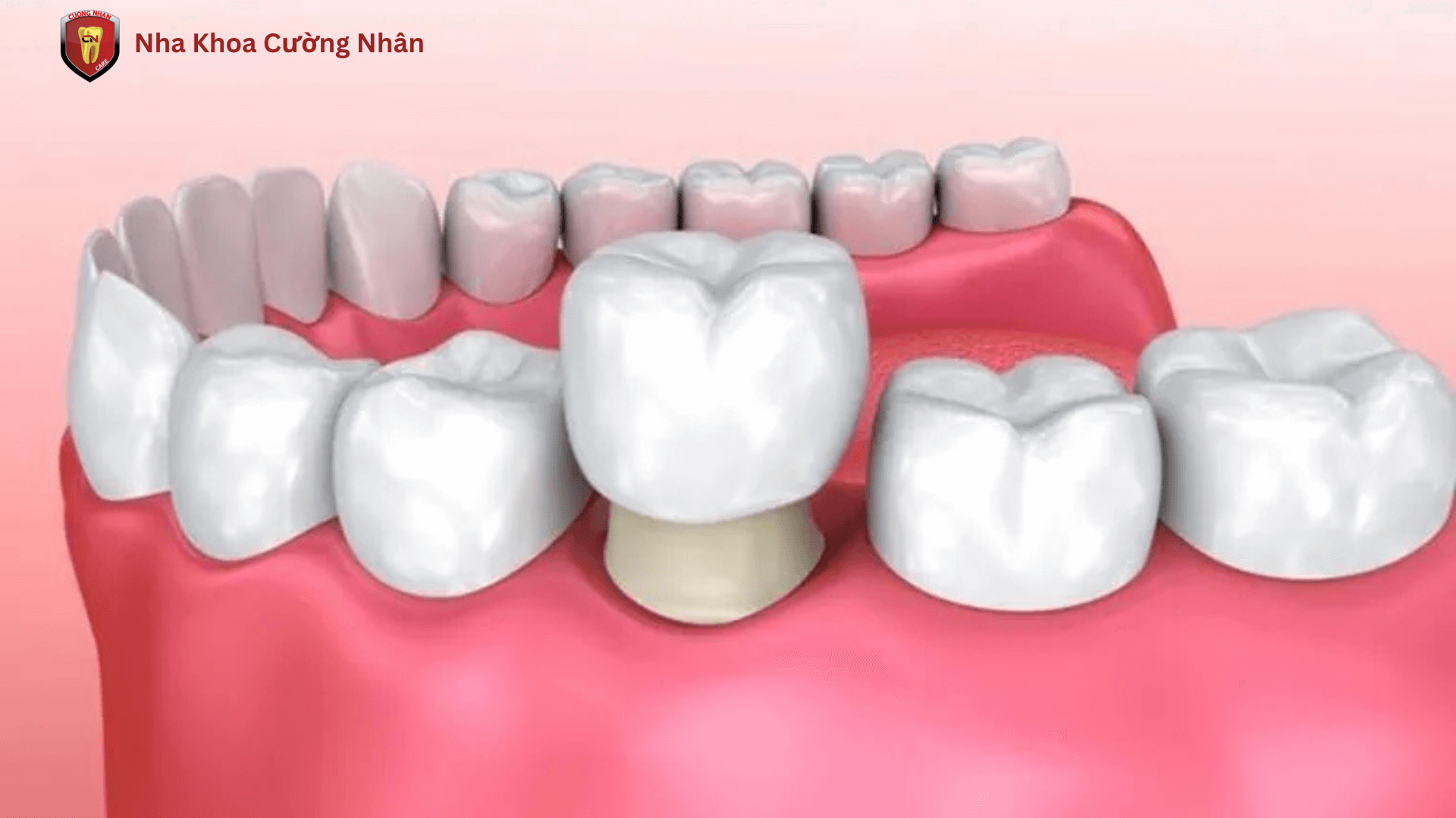Phương pháp bọc răng sứ để điều trị thưa răng