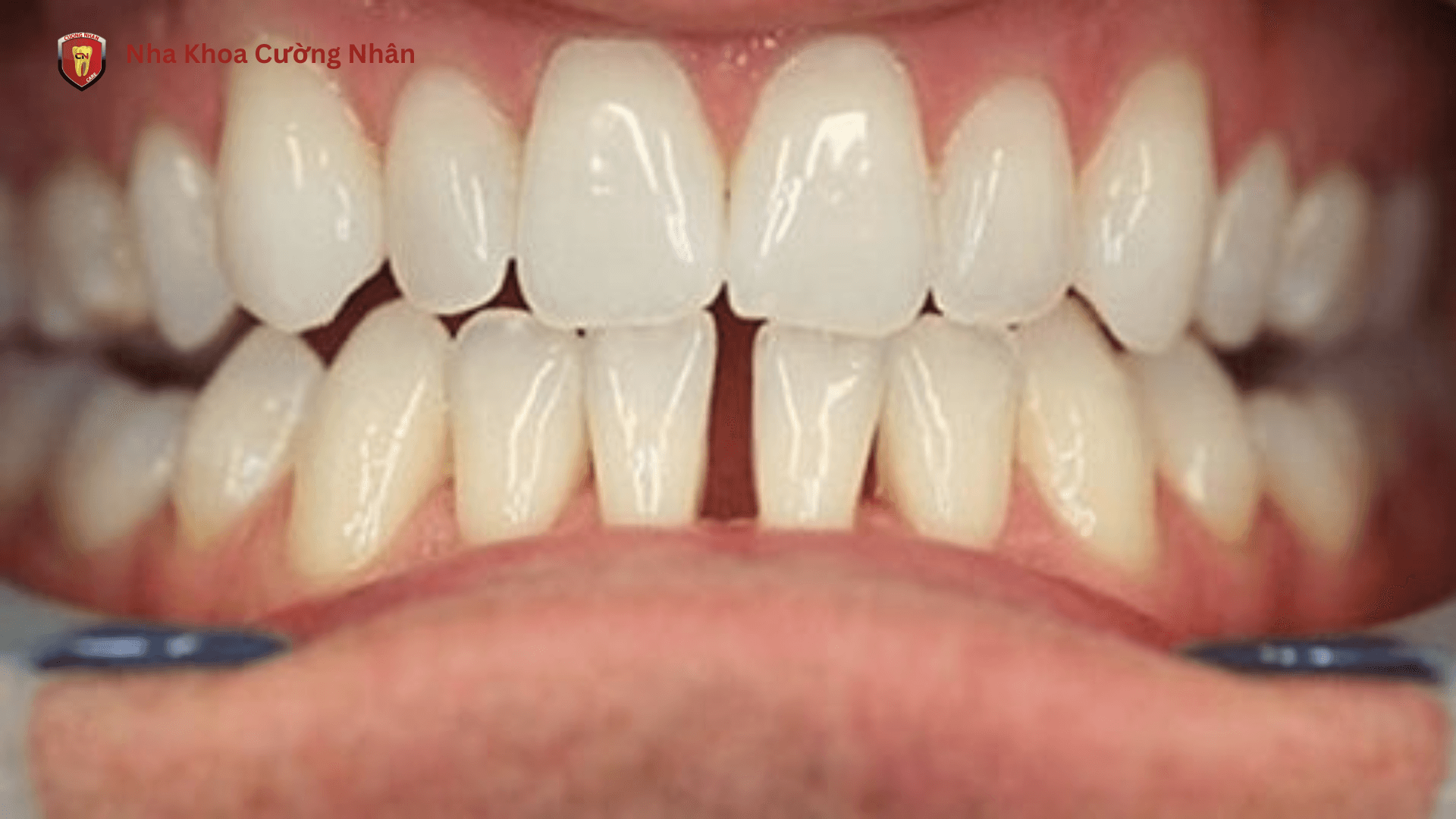 Răng thưa là gì? Nhận biết chính xác theo góc nhìn nha khoa