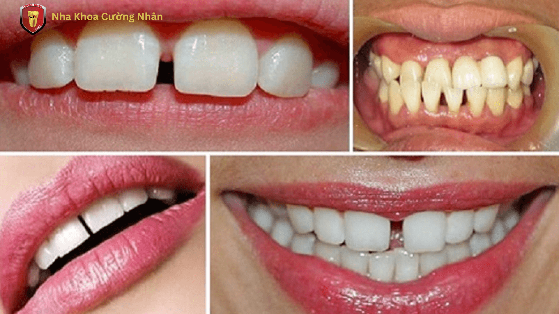 Những tác hại của răng thưa 