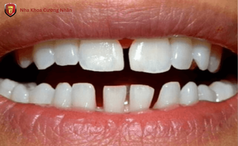 Nguyên nhân gây thưa răng do bẩm sinh hoặc di truyền