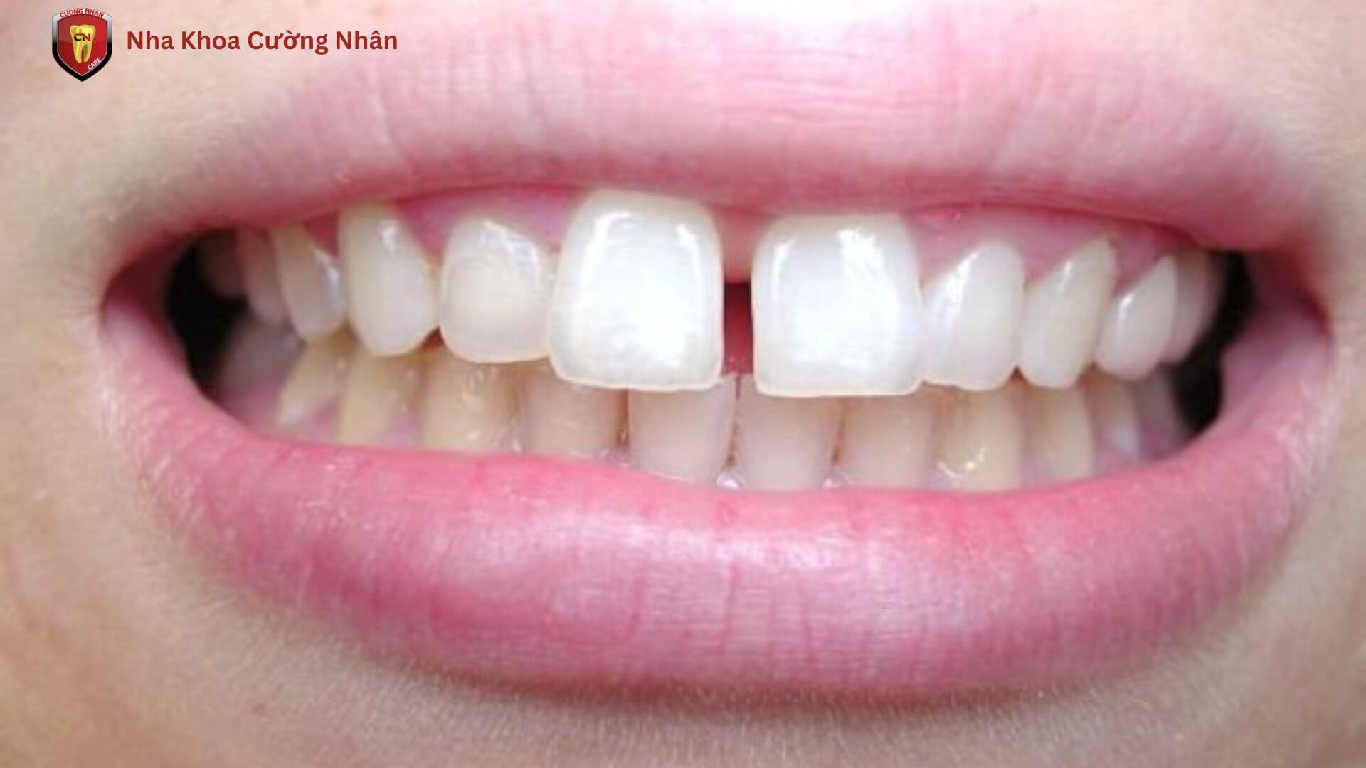 Tình trạng răng thưa nhẹ