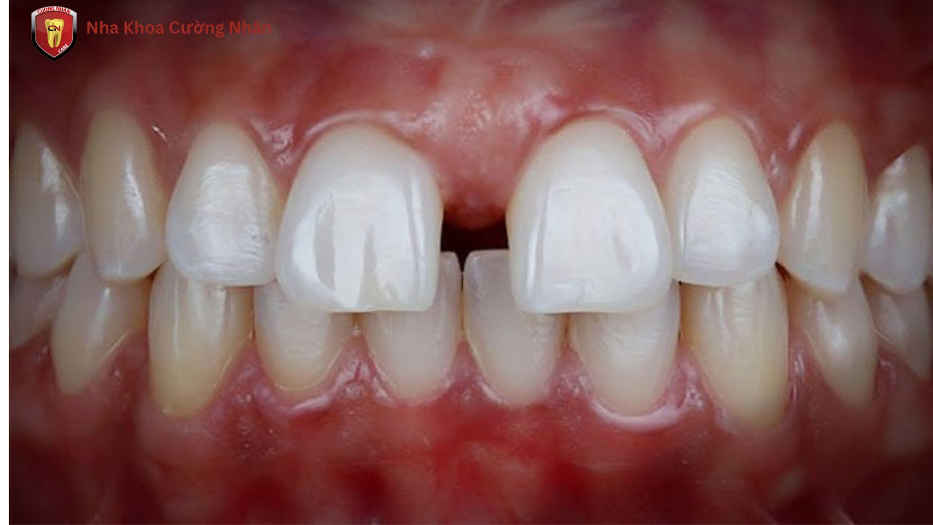 Tình trạng răng thưa mức độ trung bình