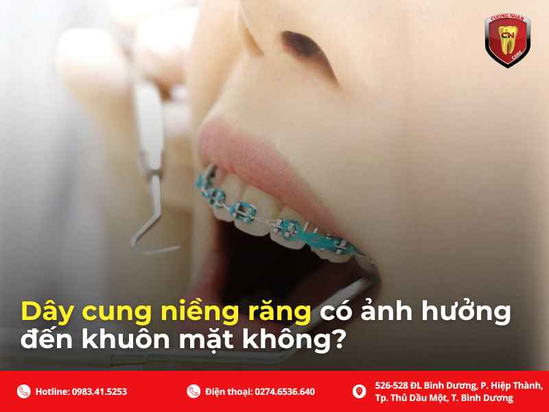 Giải đáp sử dụng dây cung niềng răng có ảnh hưởng đến gương mặt không