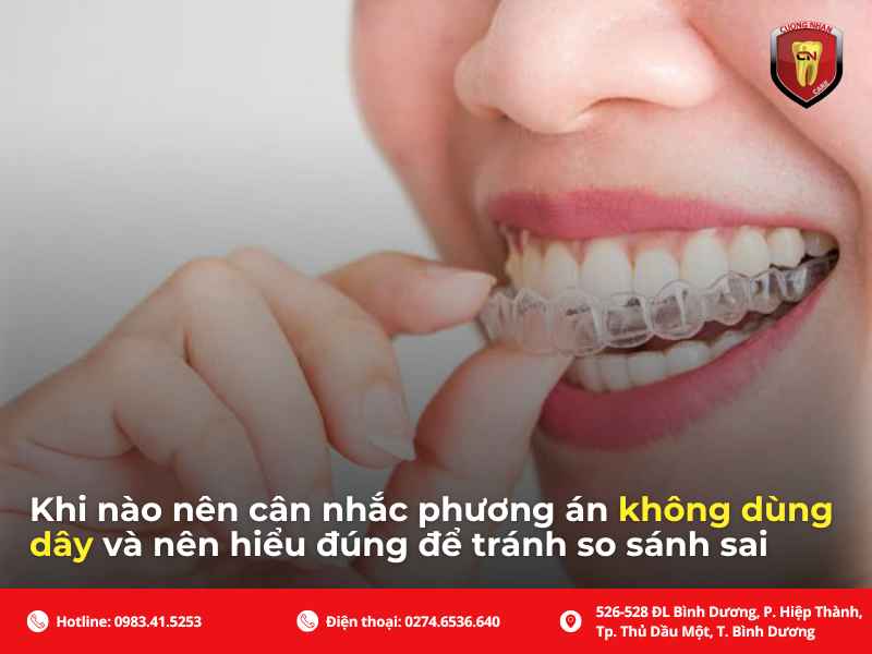 Khi nào nên và không nên sử dụng dây cung niềng răng