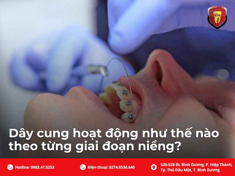 Các dây cung niềng răng hoạt động theo từng giai đoạn