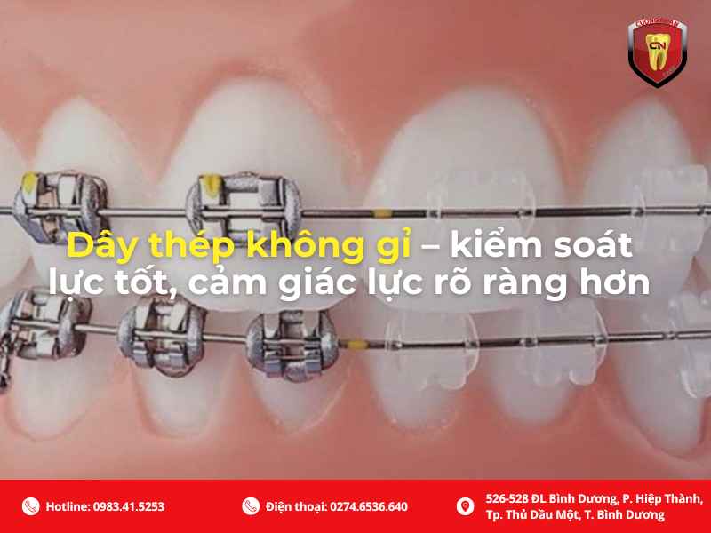 Dây cung niềng răng thép không gỉ