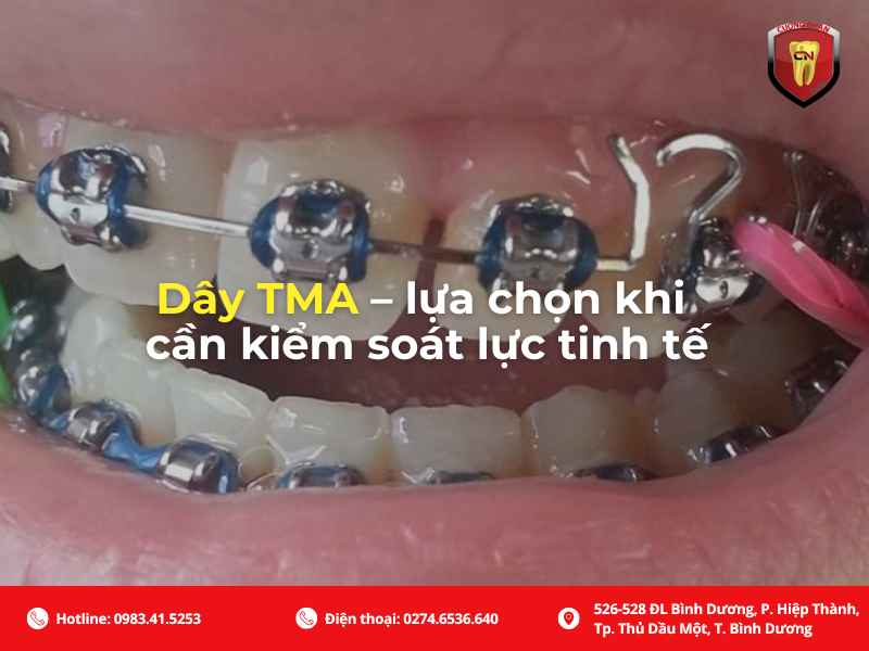 Dây cung niềng răng TMA