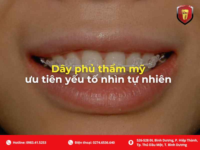 Dây cung niềng răng thẩm mỹ