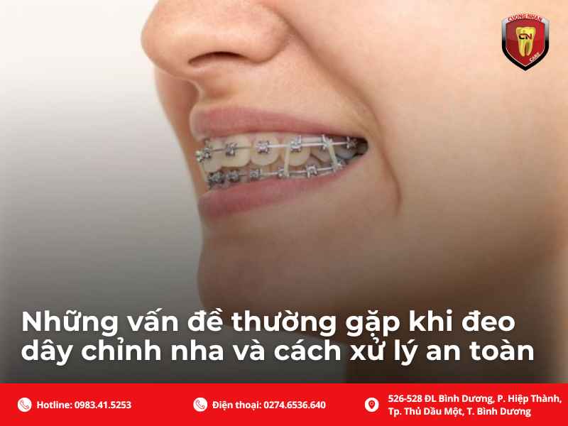 Những vấn đề thường gặp khi đeo dây cung chỉnh nha