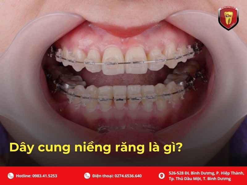 Dây cung niềng răng bị cong có sao không? Bài viết phân loại mức độ, dấu hiệu nguy hiểm, cách xử lý tạm thời, phòng tránh, và khi nào cần gặp bác sĩ.