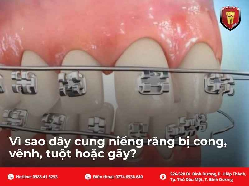 Dây cung niềng răng là gì?