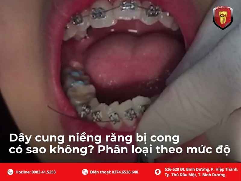 Vì sao dây cung niềng răng bị cong, vênh, tuột hoặc gãy?