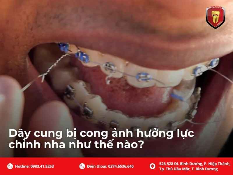 Dây cung niềng răng bị cong có sao không? Phân loại theo mức độ