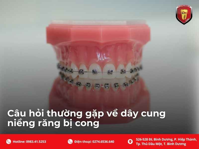 Câu hỏi thường gặp về dây cung niềng răng bị cong