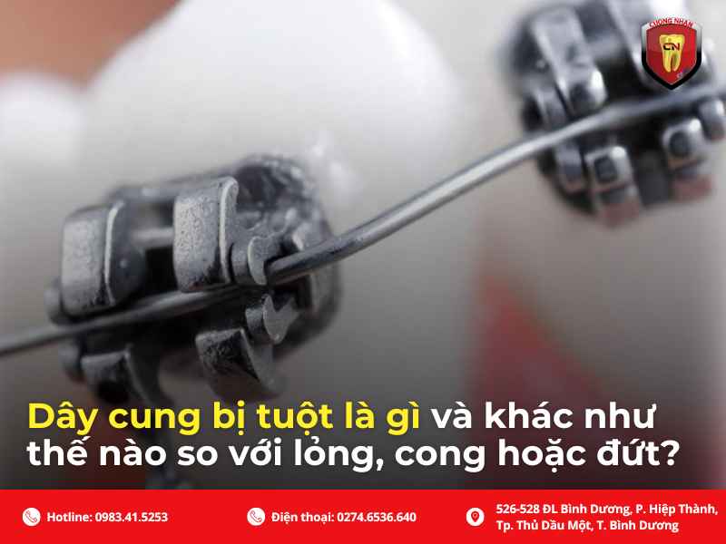 Tổng quan về vấn đề dây cung bị tuột