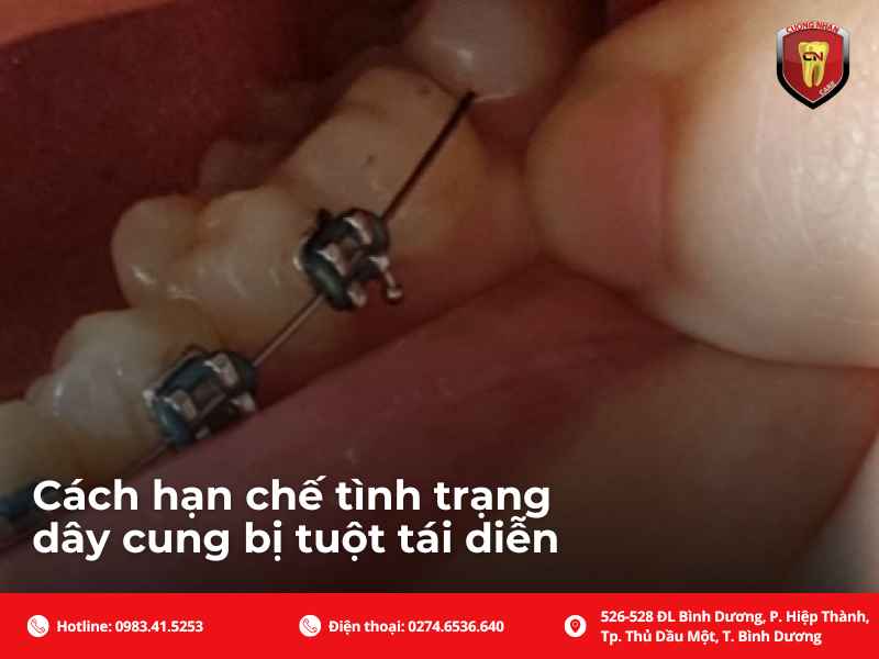 Các cách giúp phòng ngừa tình trạng dây cung niềng răng bị tuột