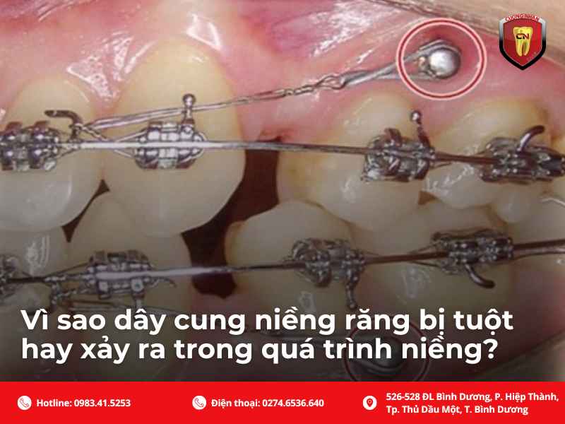 Vì sao lại có tình trạng dây cung niềng răng bị tuột ?