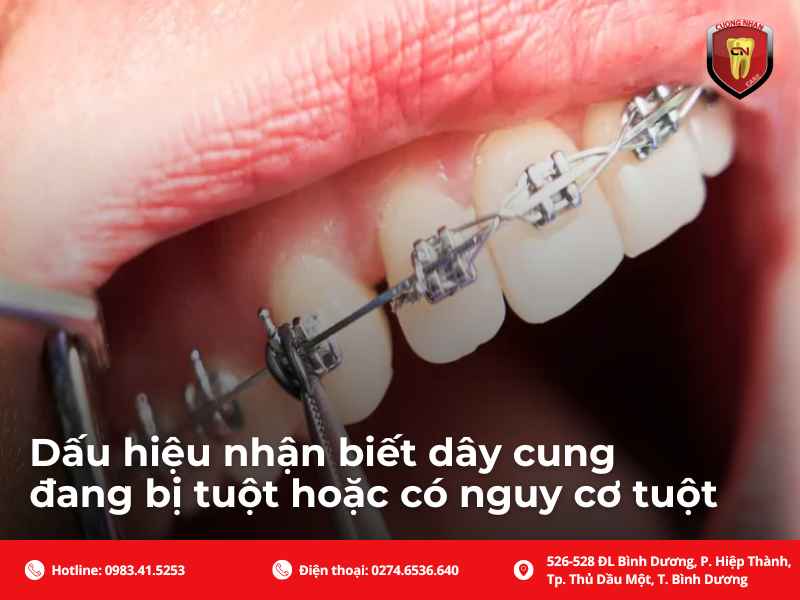 Dấu hiệu giúp nhận biết dâu cung niềng răng đang có dấu hiệu tuột
