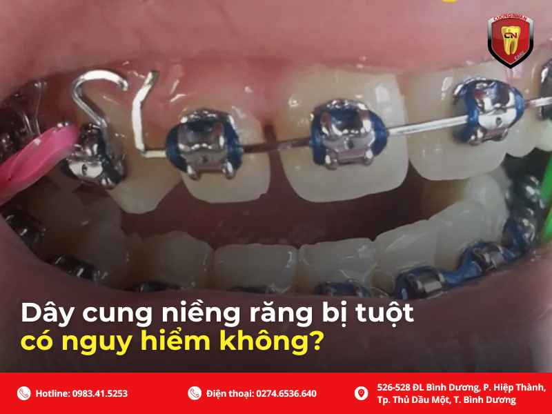 Dây cung niềng răng bị tuột có thực sự nguy hiểm ?