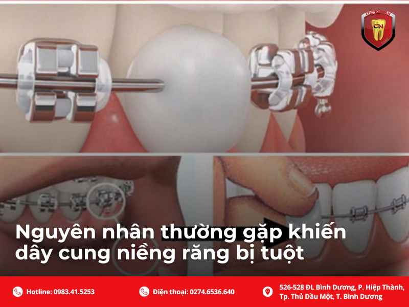 Các nguyên nhân thường gặp làm cho dây cung niềng răng bị tuột