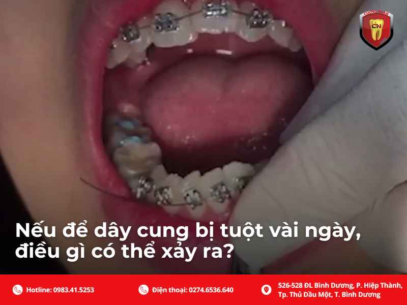 Nếu để dây cung niềng răng bị tuột lâu ngày thì có ảnh hưởng gì không ? - Giải đáp chi tiết
