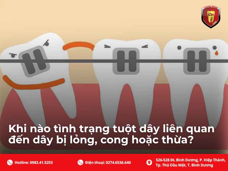 Các tình trạng liên quan đến dây cung niềng răng bị tuột