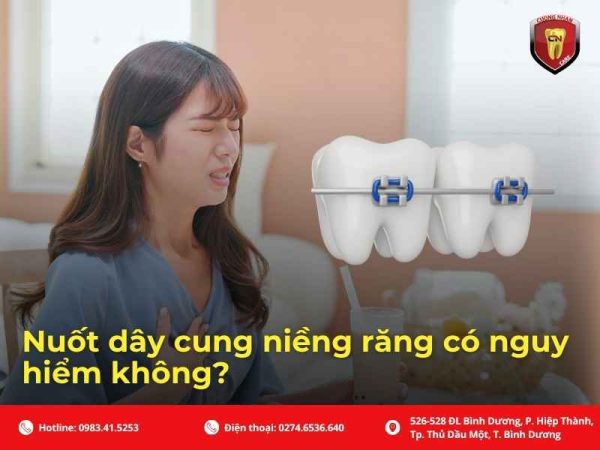 Nuốt dây cung niềng răng có sao không? Bài viết hướng dẫn nhận biết rủi ro, dấu hiệu cần đi viện, cách xử trí an toàn, và phòng tránh nuốt mắc cài.