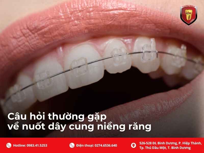 Cách phòng tránh nuốt dây cung niềng răng trong quá trình chỉnh nha