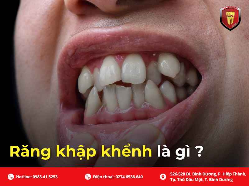 Răng khập khểnh là gì ?